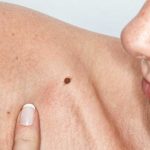 What You Need to Know about Skin Cancer- A Brief Guide