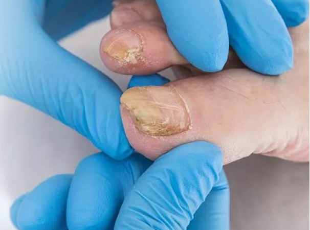 The Things You Must See Before Onychomycosis Treatment
