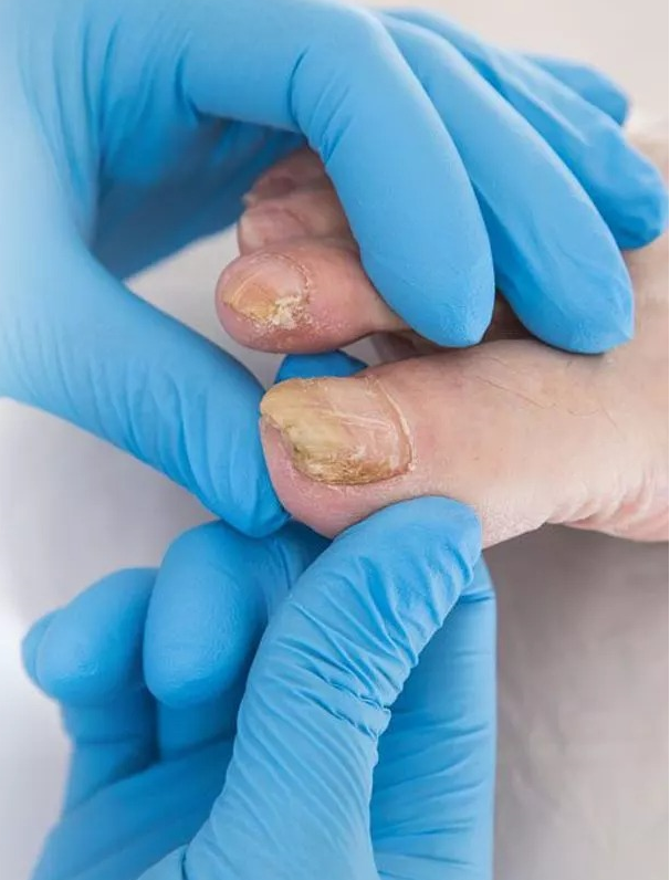 The Things You Must See Before Onychomycosis Treatment